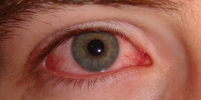 Bệnh đau mắt đỏ. Phòng tránh như thể nào cho hiệu quả?